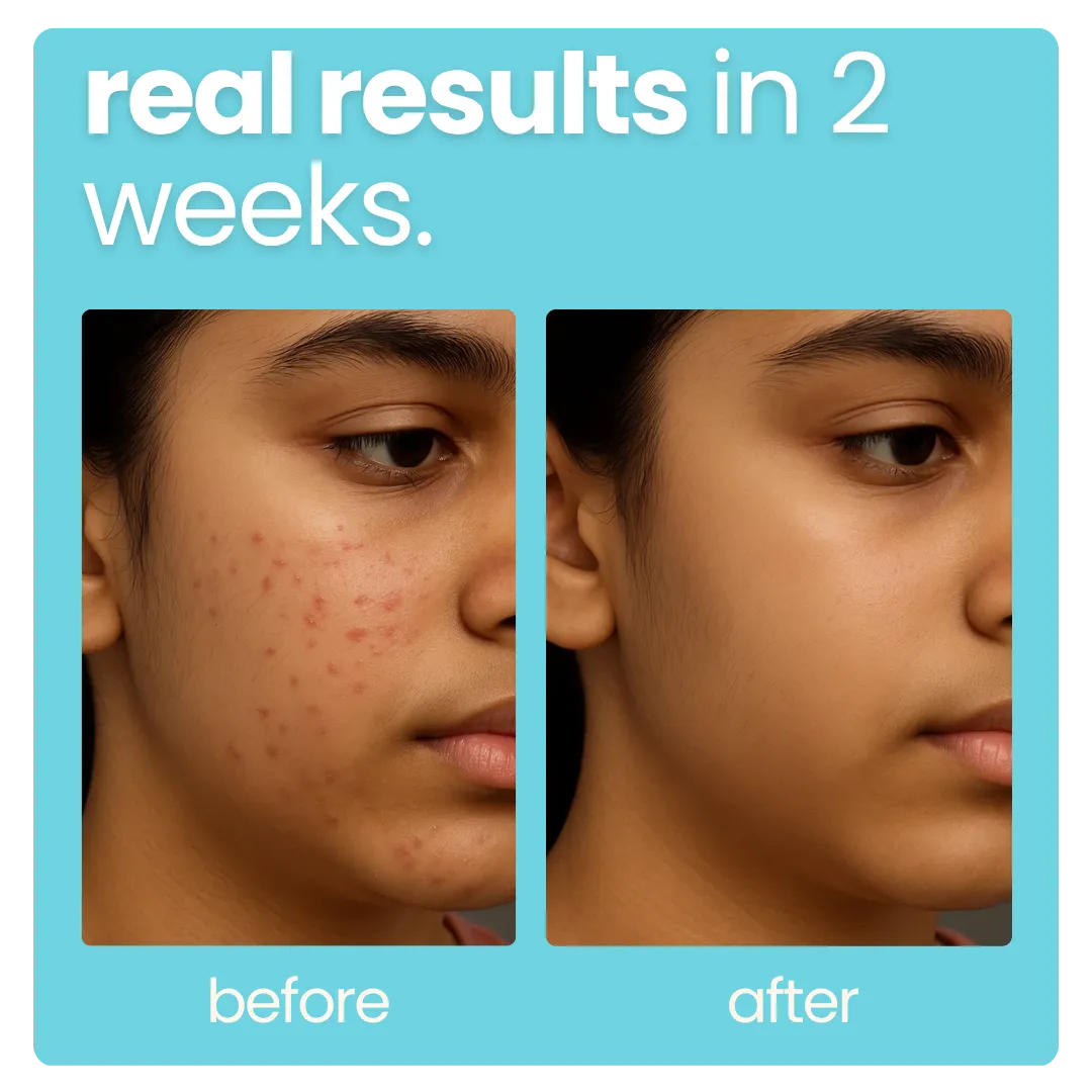 Teen Acne Kit: Oily Skin Face Wash + Weightless Face Gel