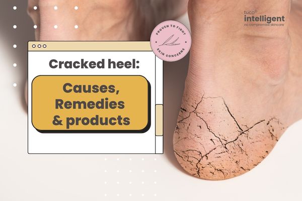 Cracked heel: Causes, Remedies, and Products