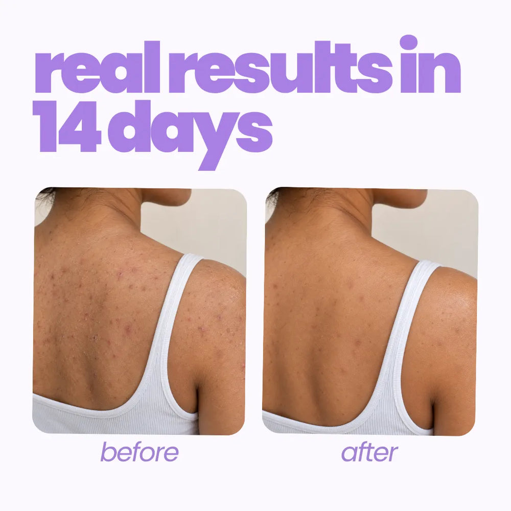 Back acne before and after 14 days of Tuco Kids Moisturising Body Spray