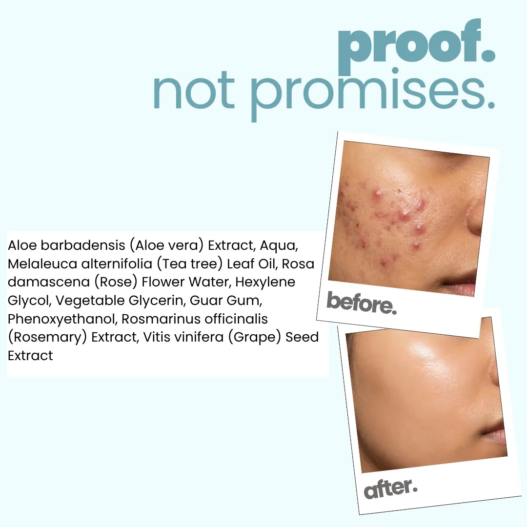 Acne Face Gel (50g)!