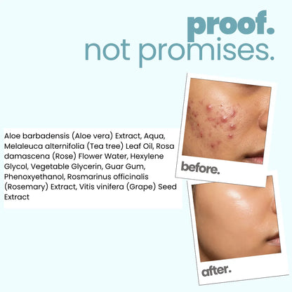 Acne Face Gel (50g)!