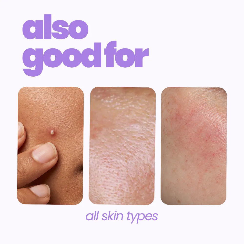 Anti-Acne Serum (10ml)