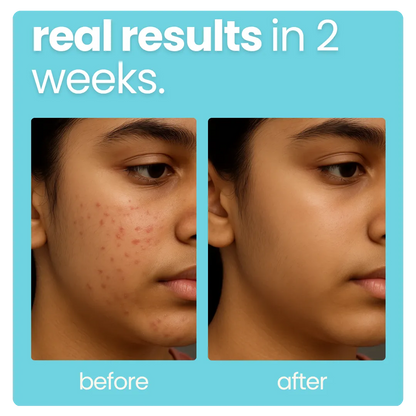 Teen Acne Kit: Oily Skin Face Wash + Weightless Face Gel