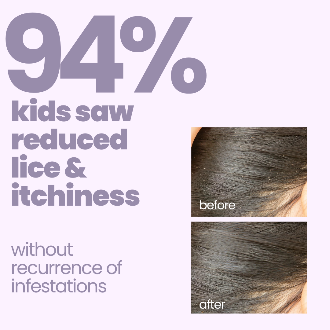 94% kids saw reduced lice and itchiness with Tuco Kids lice shampoo for kids - before and after scalp results